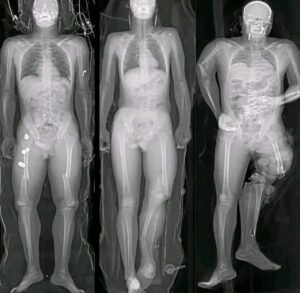 COVID 19 Alerta mundial para los vacunados